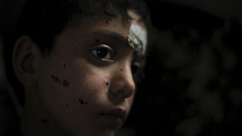 Shadi, 9 ετών, τραυματίστηκε από οβίδα κατά τη διέλευση των συνόρων από τη Συρία στο Λίβανο. Περισσότερο από το ήμισυ του πληθυσμού των προσφύγων της Συρίας λέγεται ότι είναι παιδιά. Kate Brooks
